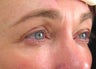 Ultherapy