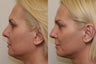 Ultherapy