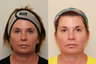 Ultherapy Lower Face