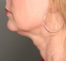Ultherapy