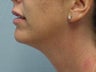 Ultherapy of Face