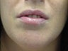 Ulthera Lip augmentation