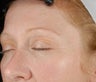 Ulthera Laser Skin Tightening