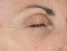 Ulthera Laser Skin Tightening