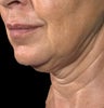 Ulthera Laser Skin Tightening