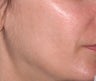 Ulthera Laser Skin Tightening