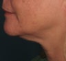 Ulthera Laser Skin Tightening