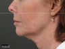Ulthera Laser Skin Tightening