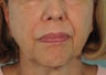 Ultherapy