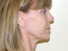 Ultherapy