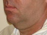 Ultherapy