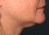 Ultherapy