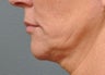 Ultherapy