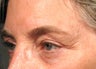 Ultherapy