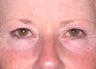 Ultherapy