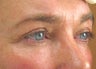 Ultherapy