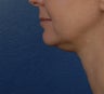 Ulthera