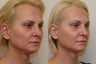Ultherapy