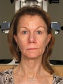 Ulthera and Sculptra