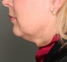 Ultherapy