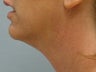 Ultherapy of Face