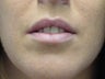 Ulthera Lip augmentation