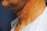 Ultherapy - immediately before and after