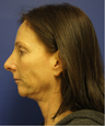 Ultherapy
