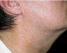 VBeam treatment for neck redness
