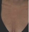 Laser treatment for sun damage