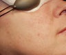 Vein Treatment