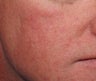 Vein treatment with V Beam