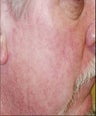 Vein treatment