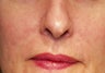 Vein treatment