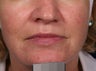 Vein treatment