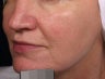 Vein treatment