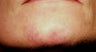 Vascular malformations or birthmarks