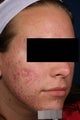 Acne laser treatment with PDT