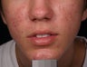 Acne laser treatment with PDT