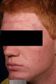 Acne laser treatment with photodynamic therapy