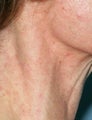 Vbeam laser treatment