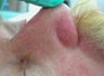 Vbeam for veins on nose