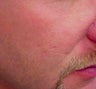 Vbeam treatment for scars