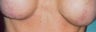 Breast implant scar removal