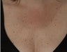 Laser treatment for sun damage