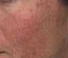 V Beam treatment for Rosacea