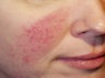 Vein Treatment