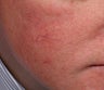 Vein treatment with V Beam