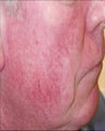 Vein treatment
