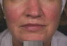 Vein treatment